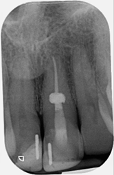 Internal resorption management - Case 2